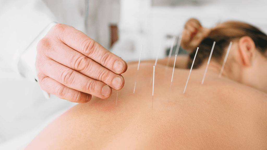 Sessão de acupuntura com aplicação de agulhas